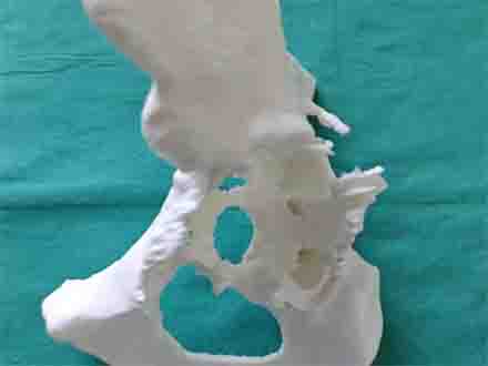 当手术遇上科技:3D打印技术远程救治髋臼缺损患者