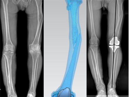 枣庄市立医院完成首例3D打印PSI辅助全膝关节置换术